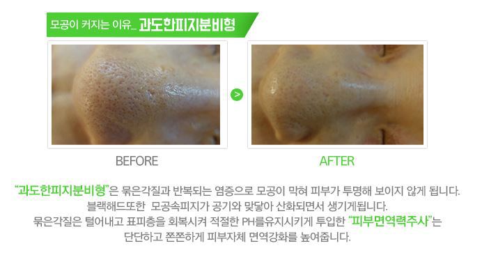 원주 피부과 모공을 작게 피부 탄력 살리다